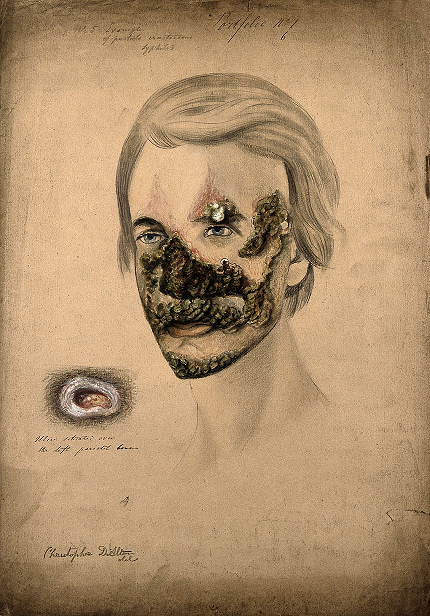 This medical illustration portrays a face which consumed by lesions from the chin to the nose, as well as the left temple and eyebrow. The legions are nearly black, with red inflammation at the periphery.